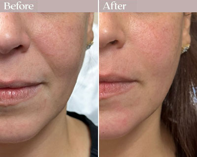 cheek fillers before after nyc